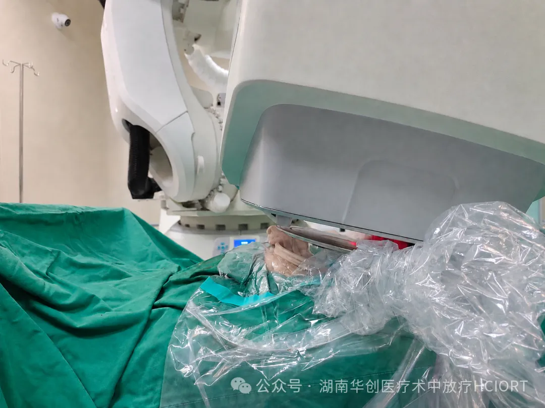 全球首例！南华大学附一院使用电子线球形施治器顺利完成腹膜后脂肪肉瘤术中放疗