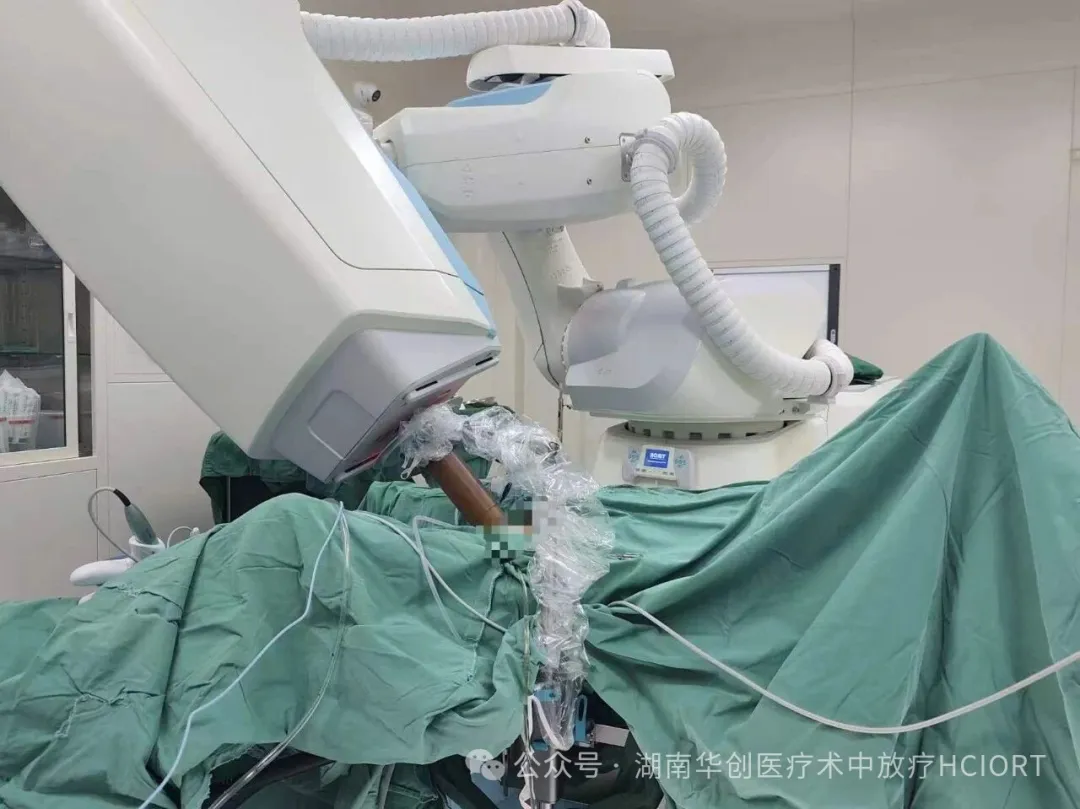 全球首例！南华大学附一院顺利完成外阴癌移动式电子线筒形施治器术中放疗