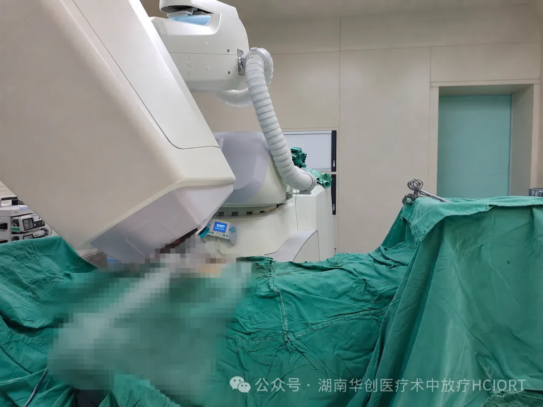 湖南首例!南华大学附一院顺利完成复发性卵巢癌术中放疗
